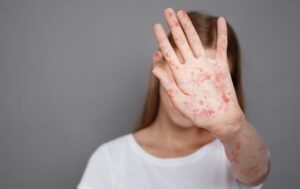Новини України - В Україні зафіксували до 1,2 тис. випадків кору з початку року
